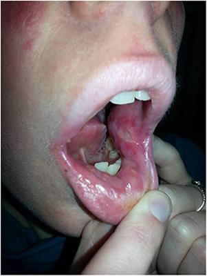 Recurrent, Severe Aphthous Stomatitis and Mucosal Ulcers as Primary Manifestations of a Novel STAT1 Gain-of-Function Mutation